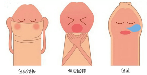 南京邦德医院专业割包皮-包茎手术需要多少时间可以恢复